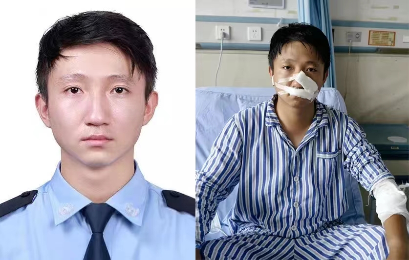 符杰(左为受伤前,右为受伤后).jpg 符杰(左为受伤前,右为受伤后).jpg